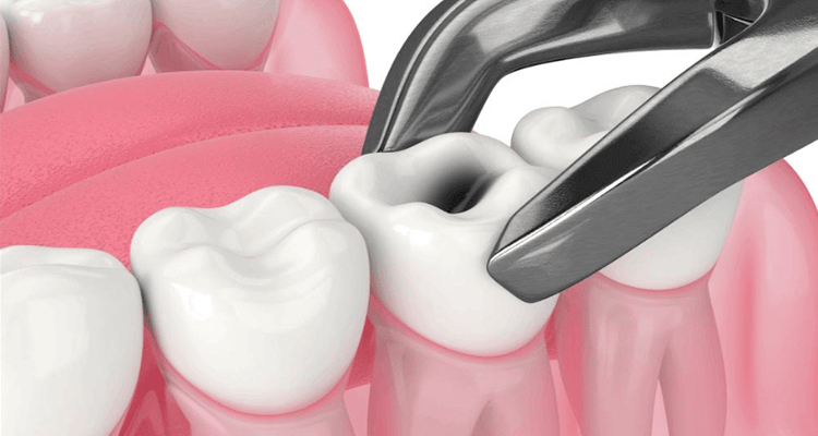 Painless Extractions